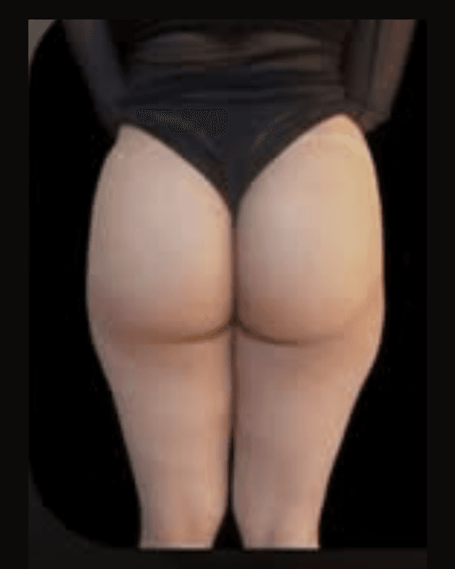 Antes do procedimento de Harmonização Corporal